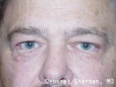 Entropion Before & After Gallery - Patient 312733 - Image 1