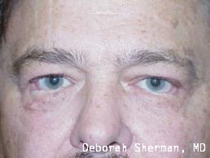 Entropion Before & After Gallery - Patient 312733 - Image 1
