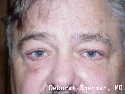 Entropion Before & After Gallery - Patient 312733 - Image 2