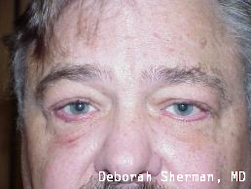 Entropion Before & After Gallery - Patient 312733 - Image 2
