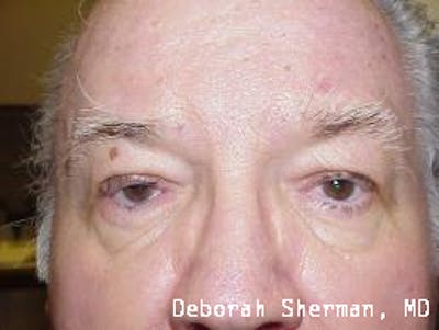 Entropion Before & After Gallery - Patient 205127 - Image 1