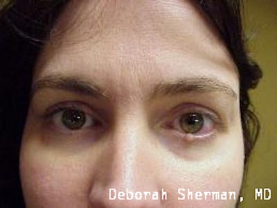 Eyelid and Orbital Tumors Before & After Gallery - Patient 158072 - Image 1