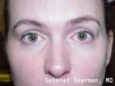 Eyelid and Orbital Tumors Before & After Gallery - Patient 158072 - Image 2