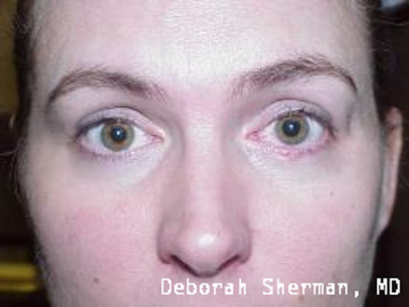 Eyelid and Orbital Tumors Before & After Gallery - Patient 158072 - Image 2
