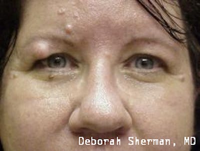 Eyelid and Orbital Tumors Before & After Gallery - Patient 790130 - Image 1