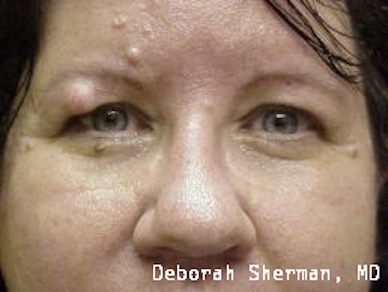 Eyelid and Orbital Tumors Before & After Gallery - Patient 790130 - Image 1