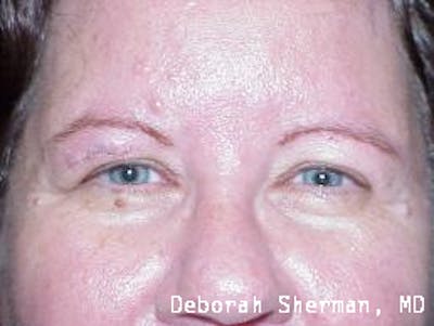 Eyelid and Orbital Tumors Before & After Gallery - Patient 790130 - Image 2