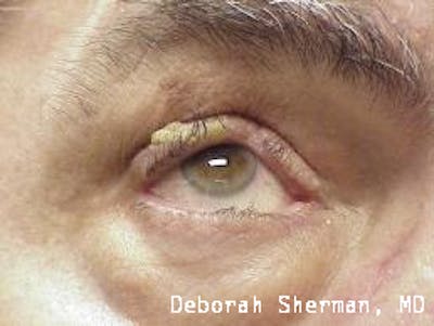 Eyelid and Orbital Tumors Before & After Gallery - Patient 321925 - Image 1