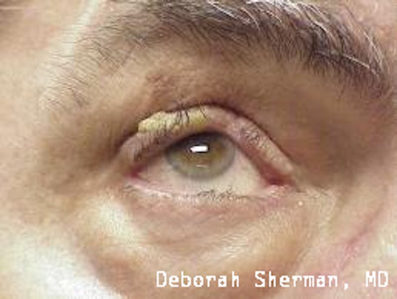 Eyelid and Orbital Tumors Before & After Gallery - Patient 321925 - Image 1