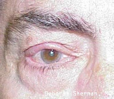 Eyelid and Orbital Tumors Before & After Gallery - Patient 321925 - Image 2