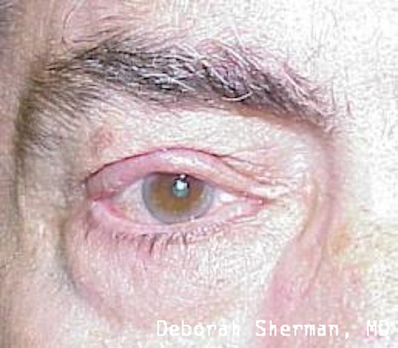 Eyelid and Orbital Tumors Before & After Gallery - Patient 321925 - Image 2