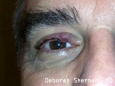 Eyelid and Orbital Tumors Before & After Gallery - Patient 239607 - Image 1