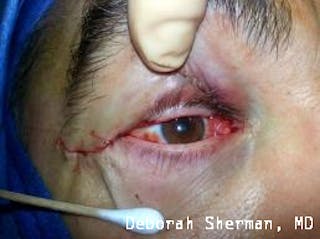 Eyelid and Orbital Tumors Before & After Gallery - Patient 239607 - Image 2