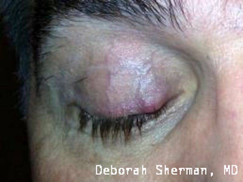 Eyelid and Orbital Tumors Before & After Gallery - Patient 239607 - Image 3
