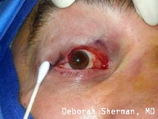 Eyelid and Orbital Tumors Before & After Gallery - Patient 239607 - Image 4