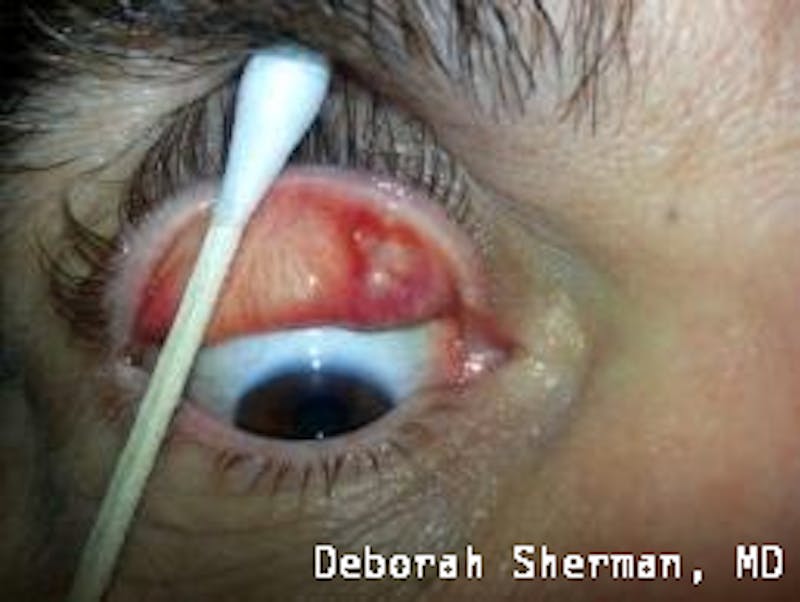 Eyelid and Orbital Tumors Before & After Gallery - Patient 239607 - Image 5