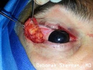 Eyelid and Orbital Tumors Before & After Gallery - Patient 239607 - Image 6
