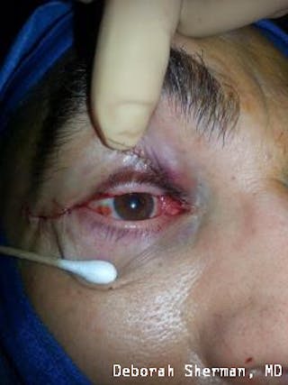 Eyelid and Orbital Tumors Before & After Gallery - Patient 239607 - Image 8