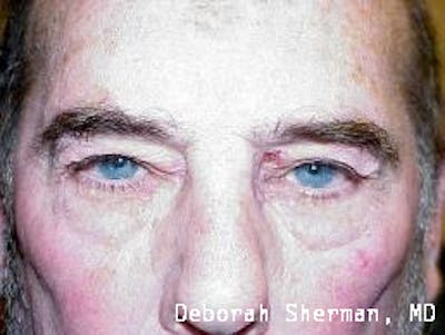 Eyelid and Orbital Tumors Before & After Gallery - Patient 121597 - Image 1