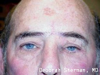 Eyelid and Orbital Tumors Before & After Gallery - Patient 121597 - Image 2