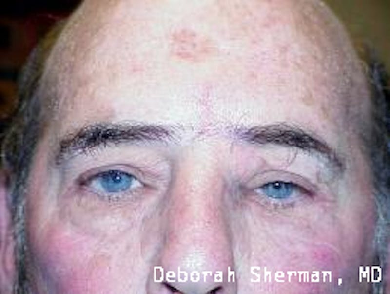 Eyelid and Orbital Tumors Before & After Gallery - Patient 121597 - Image 2
