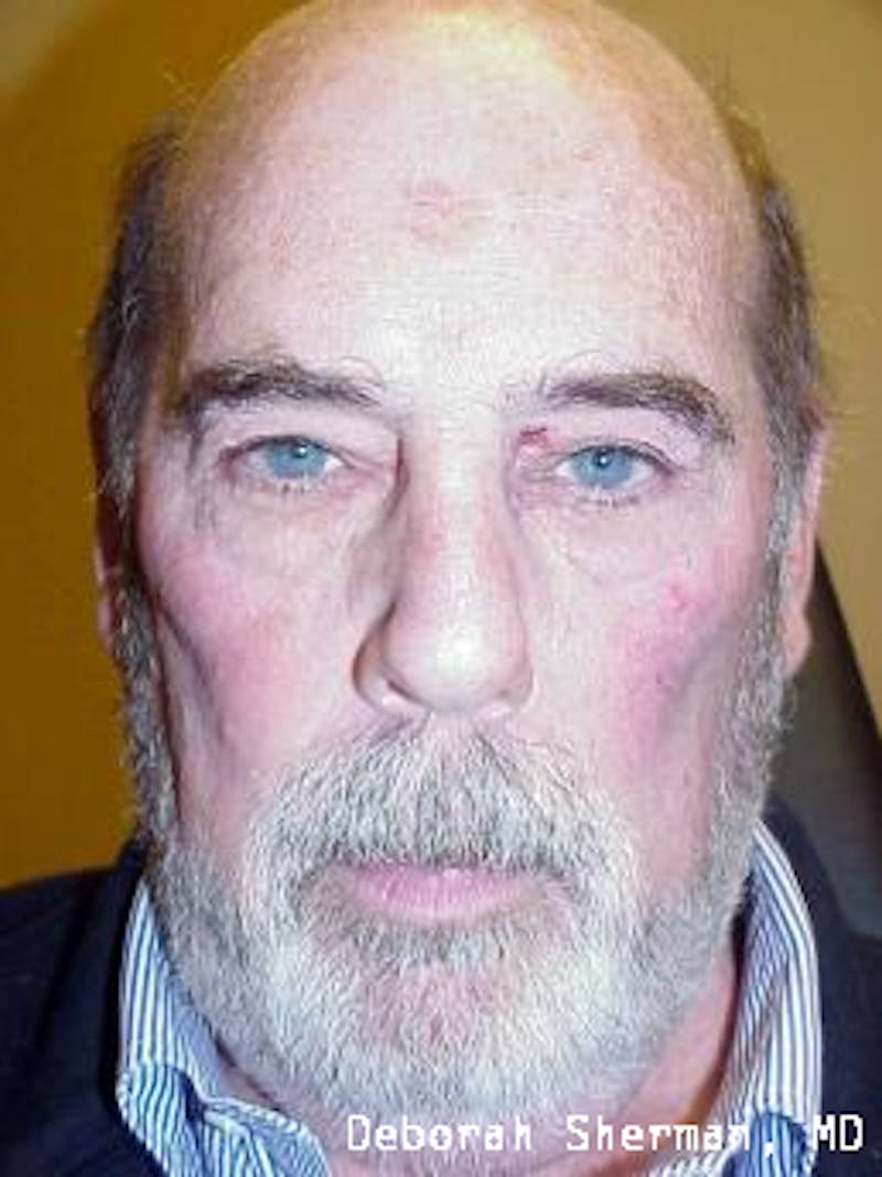 Eyelid and Orbital Tumors Before & After Gallery - Patient 121597 - Image 3