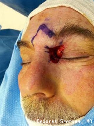 Eyelid and Orbital Tumors Before & After Gallery - Patient 121597 - Image 4