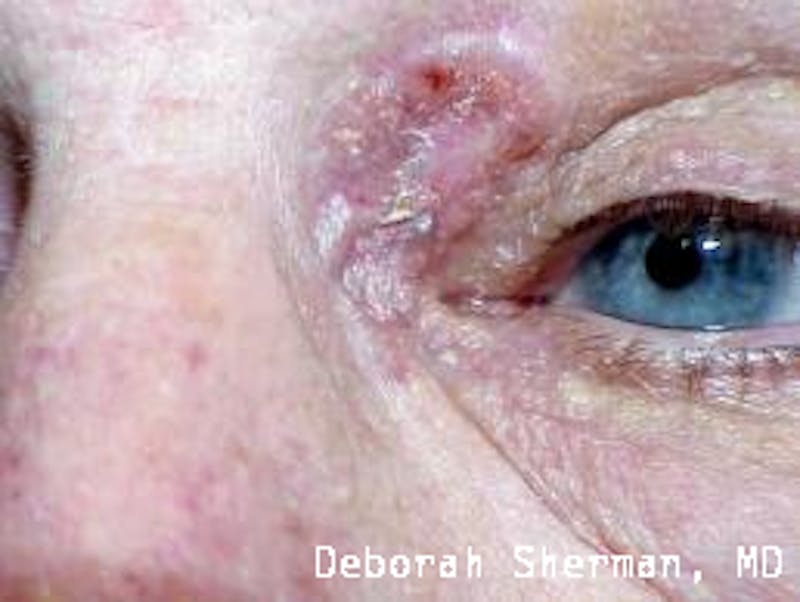 Eyelid and Orbital Tumors Before & After Gallery - Patient 121597 - Image 5