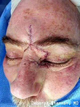 Eyelid and Orbital Tumors Before & After Gallery - Patient 121597 - Image 6