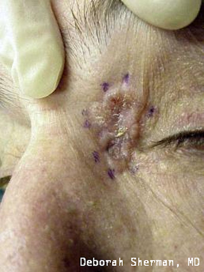 Eyelid and Orbital Tumors Before & After Gallery - Patient 121597 - Image 7