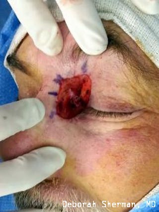 Eyelid and Orbital Tumors Before & After Gallery - Patient 121597 - Image 8