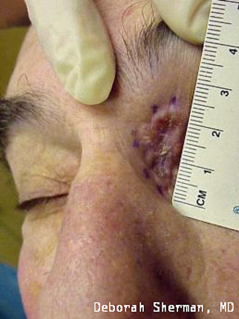 Eyelid and Orbital Tumors Before & After Gallery - Patient 121597 - Image 9