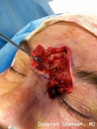 Eyelid and Orbital Tumors Before & After Gallery - Patient 121597 - Image 10