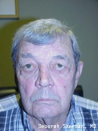 Lid Retraction Before & After Gallery - Patient 419232 - Image 1