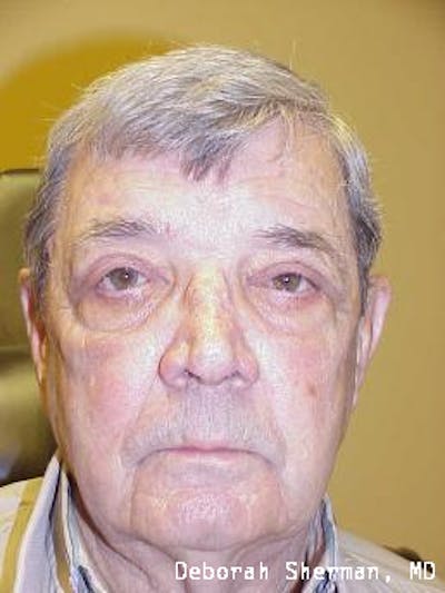 Lid Retraction Before & After Gallery - Patient 419232 - Image 2