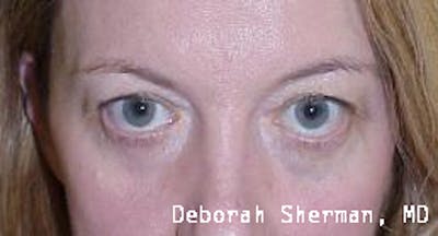 Lid Retraction Before & After Gallery - Patient 424771 - Image 1