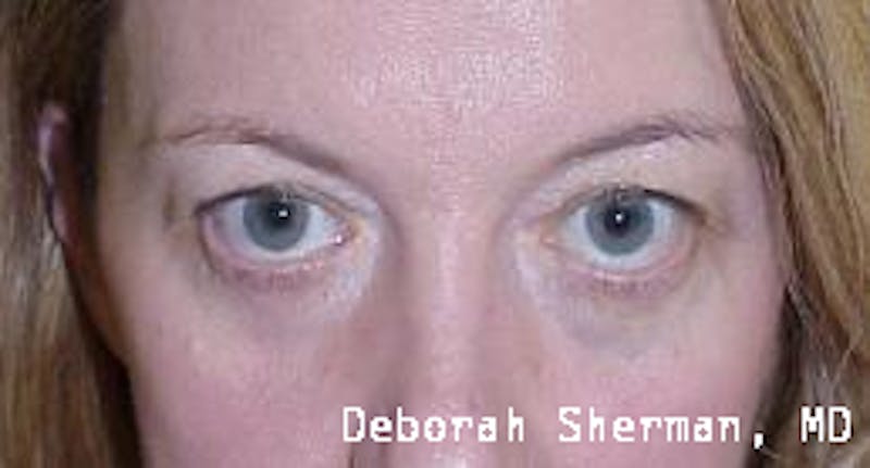 Lid Retraction Before & After Gallery - Patient 424771 - Image 1