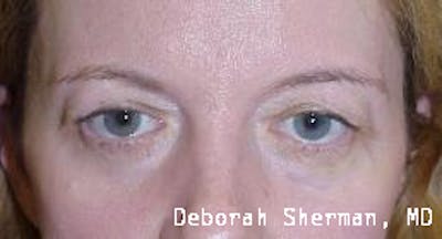 Lid Retraction Before & After Gallery - Patient 424771 - Image 2
