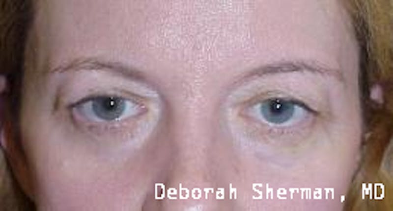 Lid Retraction Before & After Gallery - Patient 424771 - Image 2