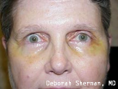 Lid Retraction Before & After Gallery - Patient 399168 - Image 1