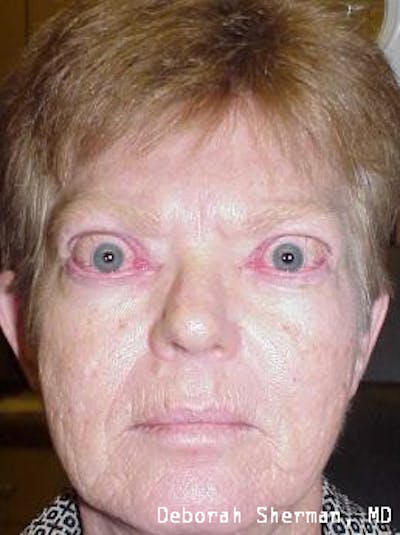 Lid Retraction Before & After Gallery - Patient 130304 - Image 1