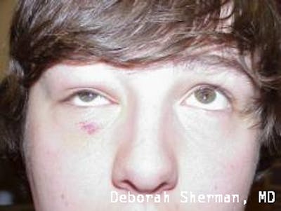 Orbital Fracture Before & After Gallery - Patient 216966 - Image 1