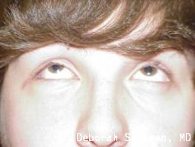 Orbital Fracture Before & After Gallery - Patient 216966 - Image 2