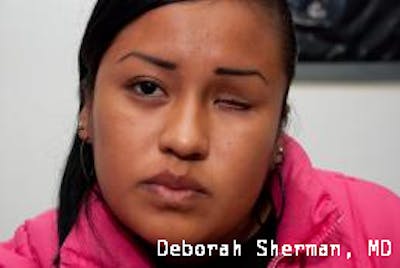 Artificial Eye Before & After Gallery - Patient 426561 - Image 1