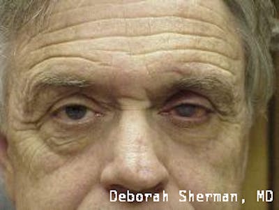Artificial Eye Before & After Gallery - Patient 311770 - Image 1