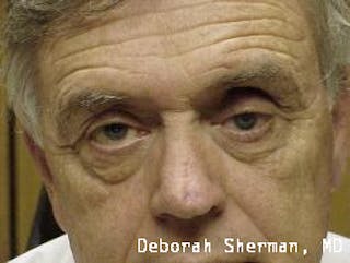 Artificial Eye Before & After Gallery - Patient 311770 - Image 2