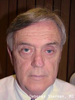 Artificial Eye Before & After Gallery - Patient 311770 - Image 4