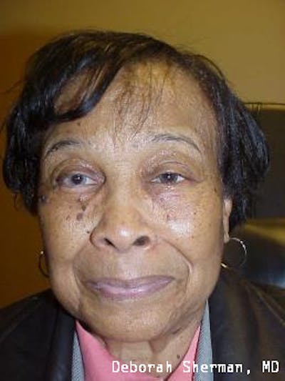 Artificial Eye Before & After Gallery - Patient 219878 - Image 2
