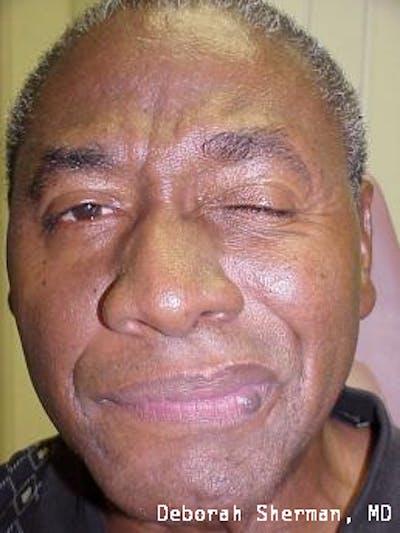 Hemifacial Spasm Before & After Gallery - Patient 635571 - Image 1