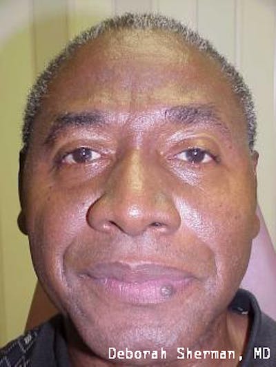 Hemifacial Spasm Before & After Gallery - Patient 635571 - Image 2